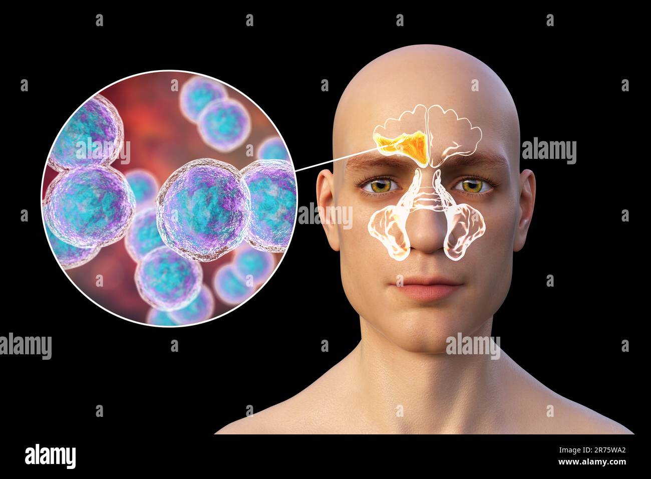 Moraxella-catarrhalis-Bakterien als Ursache einer Sinusitis. Computerdarstellung einer Entzündung der Stirnhöhlen und Nahaufnahme von Moraxella B. Stockfoto