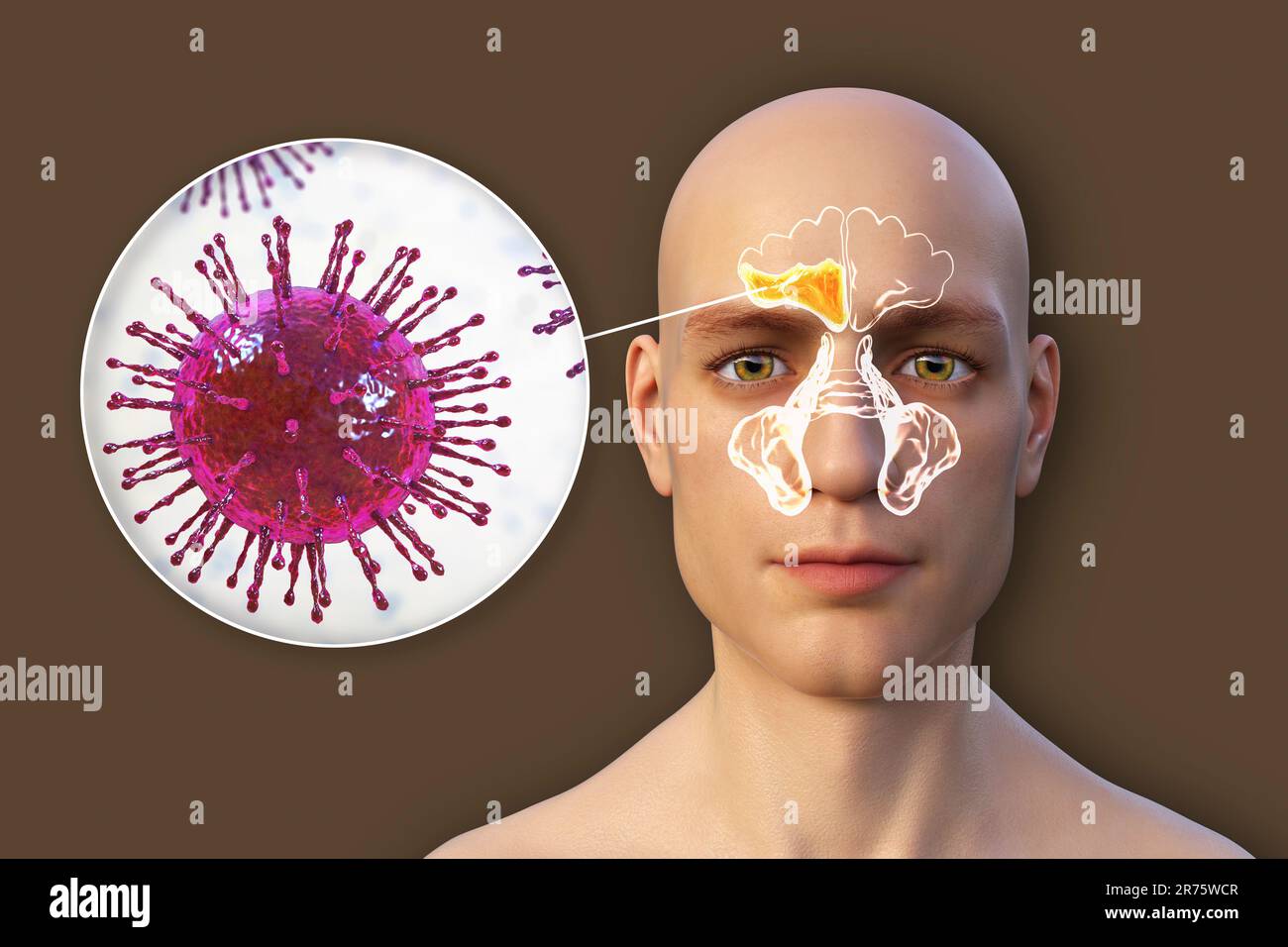 Virale Sinusitis, Computerdarstellung. Sinusitis, auch als Sinusinfektion oder Rhinosinusitis bezeichnet, ist eine Entzündung der Nasennebenhöhlen, die zu einem Symp führt Stockfoto