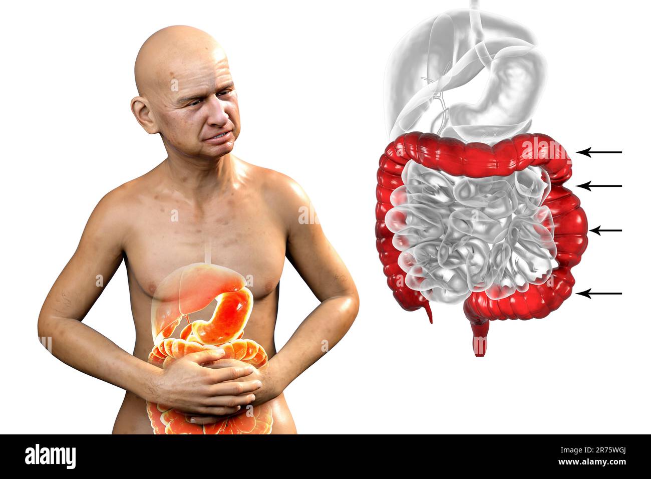 Bauchschmerzen und Krämpfe bei einem Mann durch Reizdarmsyndrom (RDS), konzeptionelle Computerdarstellung mit hervorgehobenem Darm und Isolat Stockfoto
