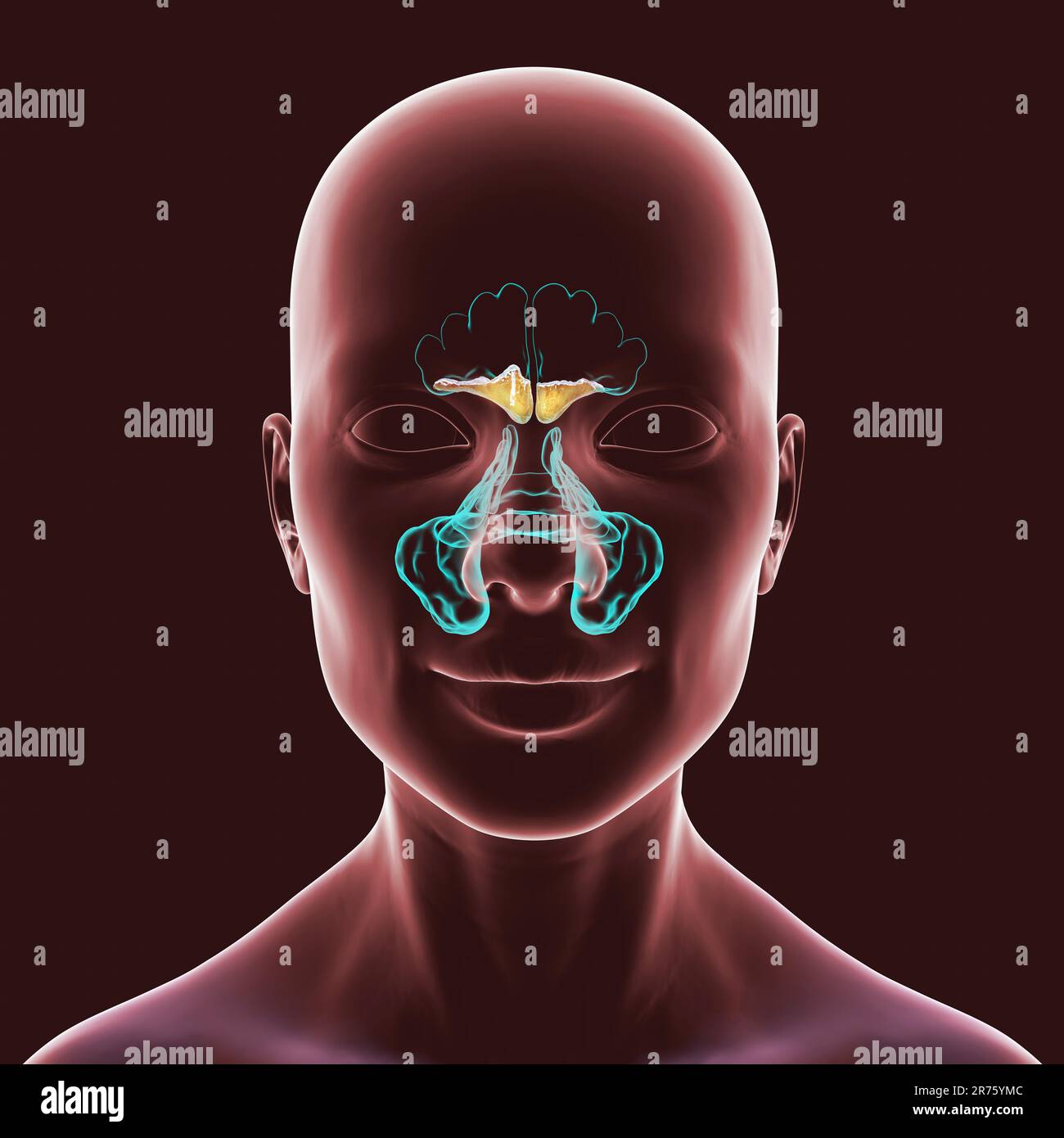 Sinusitis, Computerdarstellung. Die Nasennebenhöhlen sind membrangesäumte, luftgefüllte Räume in den Knochen des Gesichts. Die Stirnhöhlen befinden sich über den Augen. B Stockfoto
