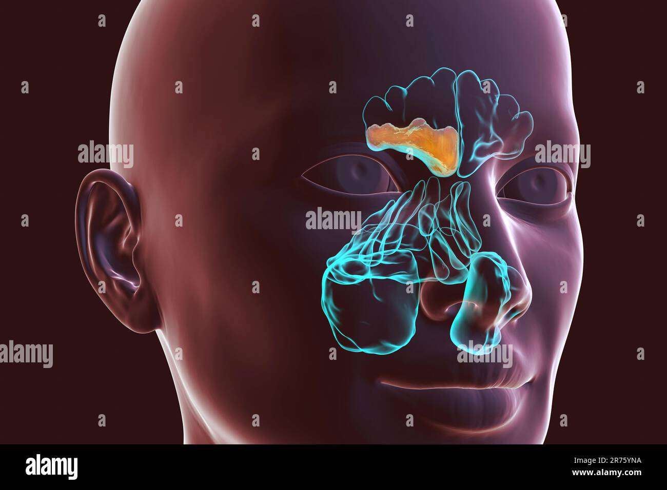 Sinusitis, Computerdarstellung. Die Nasennebenhöhlen sind membrangesäumte, luftgefüllte Räume in den Knochen des Gesichts. Die Stirnhöhlen befinden sich über den Augen. B Stockfoto