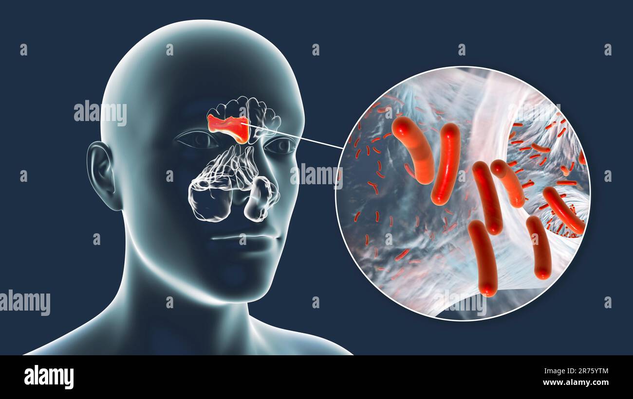 Bakterielle Sinusitis, Computerdarstellung. Die Nasennebenhöhlen sind membrangesäumte, luftgefüllte Räume in den Knochen des Gesichts. Die Stirnhöhlen liegen über t Stockfoto