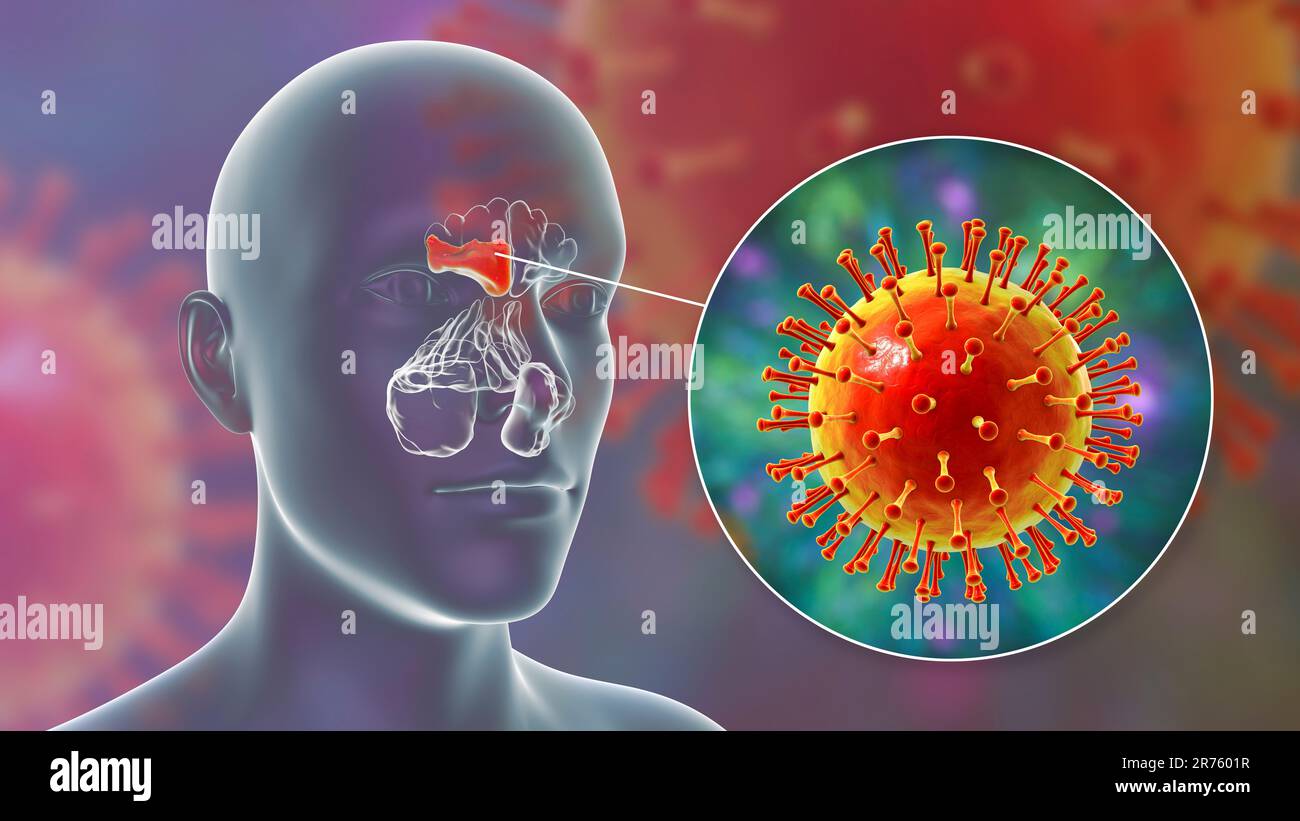 Virale Sinusitis, Computerdarstellung. Die Nasennebenhöhlen sind membrangesäumte, luftgefüllte Räume in den Knochen des Gesichts. Die Stirnhöhlen befinden sich über dem e Stockfoto