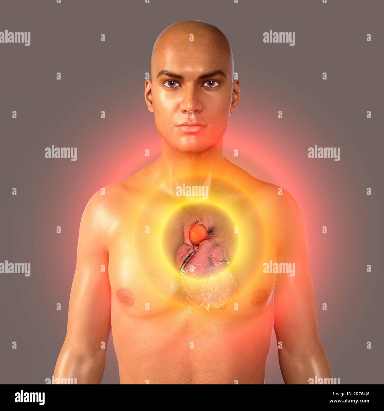 Aortenaneurysma. Computer Bild zeigt ein Aneurysma in der Aorta ascendens. Stockfoto