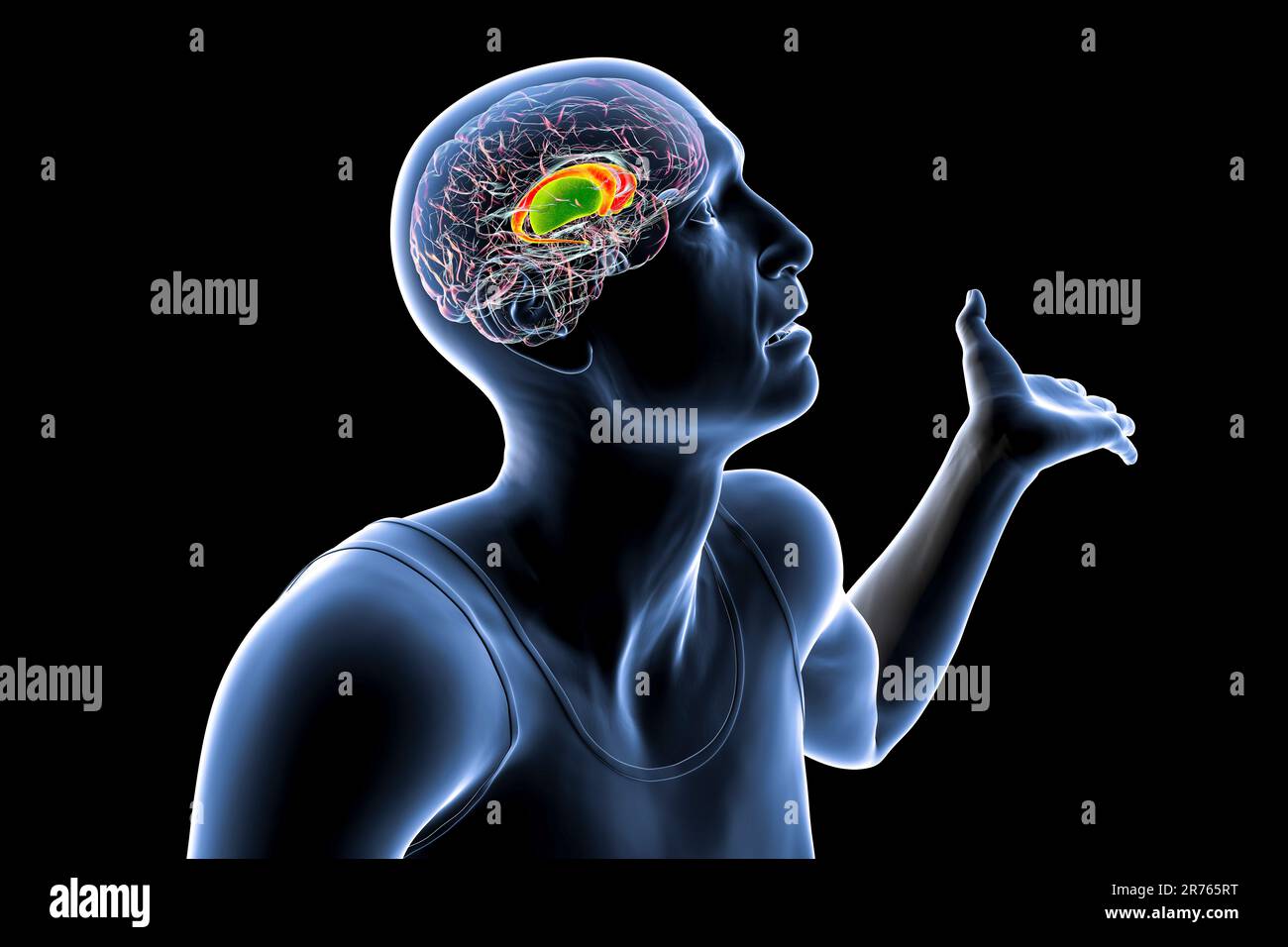 Dorsales Striatum, Nucleus caudatus und Putamen, hervorgehoben im Gehirn einer Person mit Huntington-Krankheit mit unwillkürlichen Bewegungen, konzeptionelle CO Stockfoto
