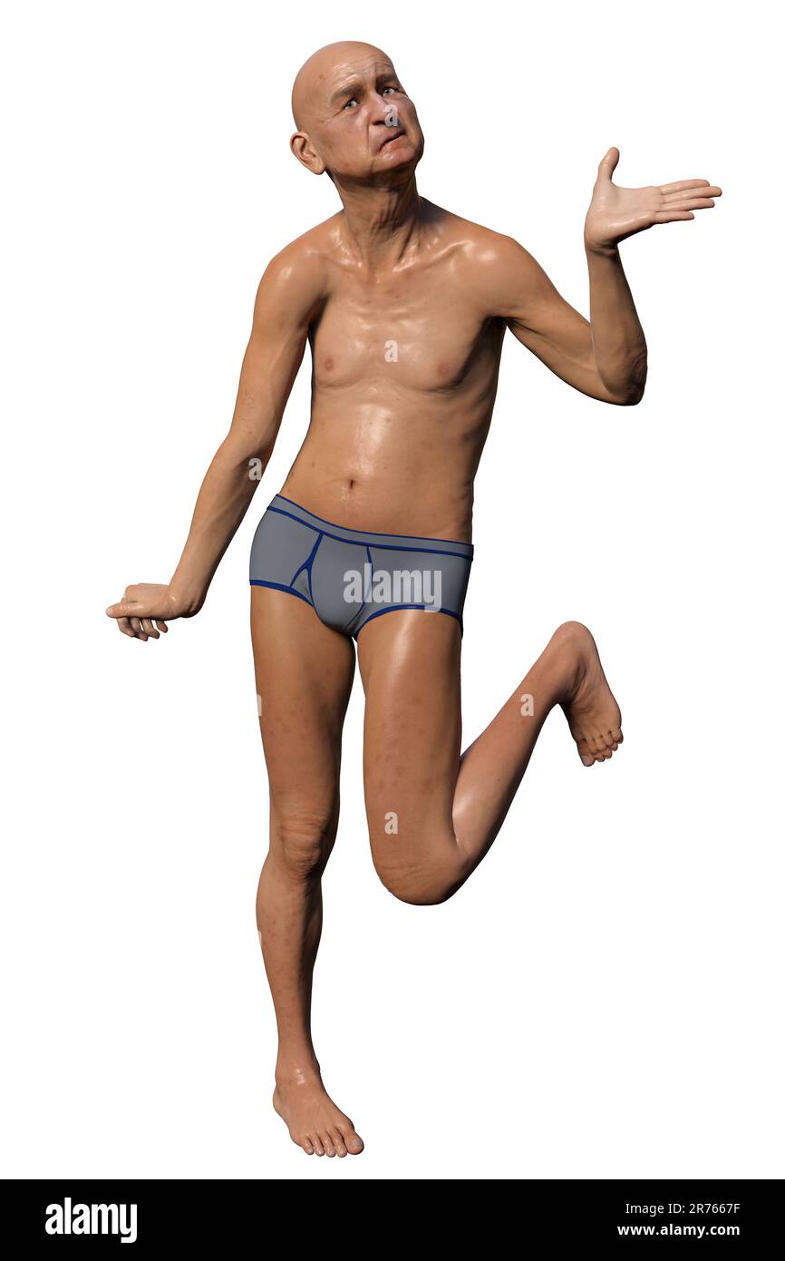 Eine Person mit Chorea Huntington, einer neurodegenerativen Erkrankung aufgrund einer Mutation im HTT-Gen, Veränderungen in den Basalganglien des Gehirns, die zu einer zufälligen Uncon führen Stockfoto