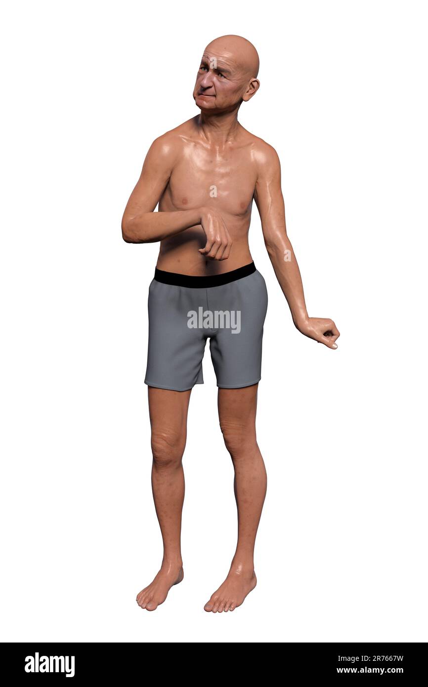 Eine Person mit Chorea Huntington, einer neurodegenerativen Erkrankung aufgrund einer Mutation im HTT-Gen, Veränderungen in den Basalganglien des Gehirns, die zu einer zufälligen Uncon führen Stockfoto