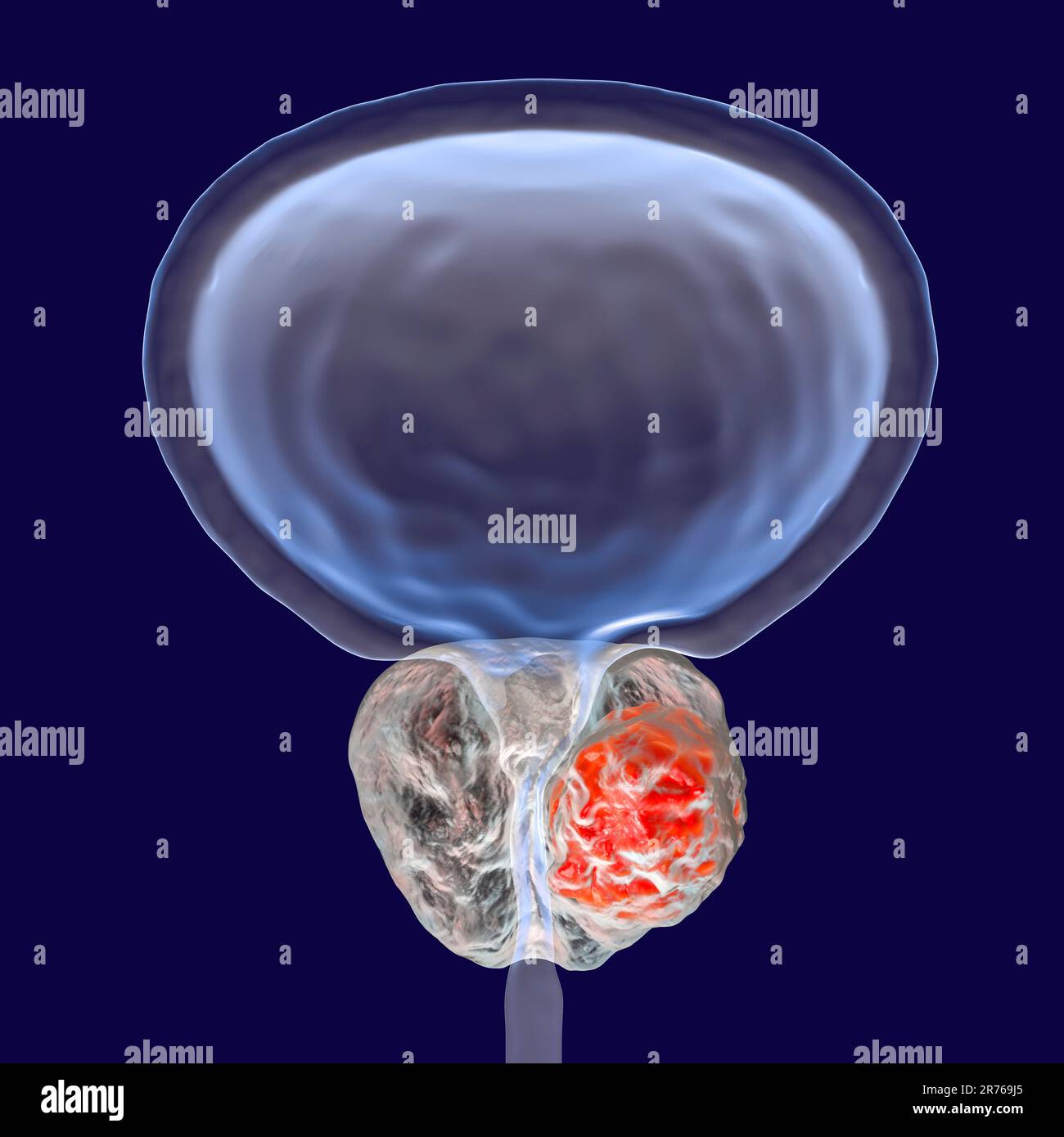 Prostatakarzinom. Computerdarstellung eines Krebstumors (Mitte rechts) in der Prostata (weiß, Mitte). Die Harnröhre läuft entlang der Stockfoto