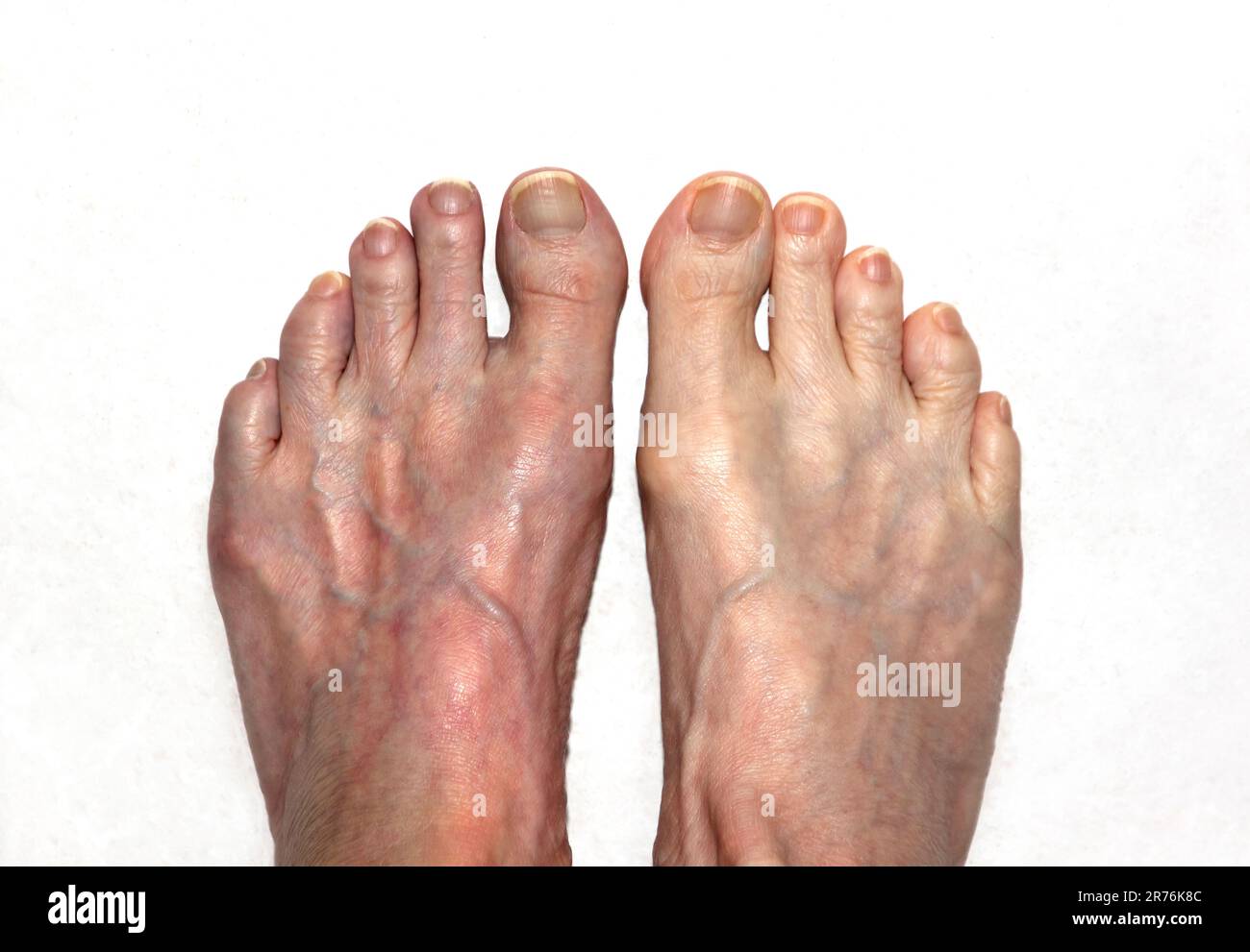 Nahaufnahme der Füße einer Person, linker Fuß rot, rechter Fuß normal. Stockfoto