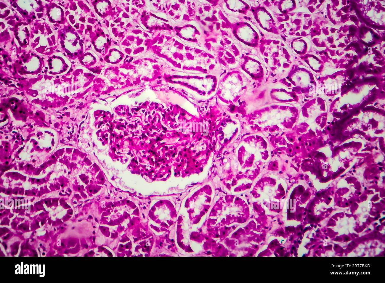 Glomerulonephritis. Lichtmikrographisches Nierengewebe bei diffuser sklerosierender Glomerulonephritis. Stockfoto