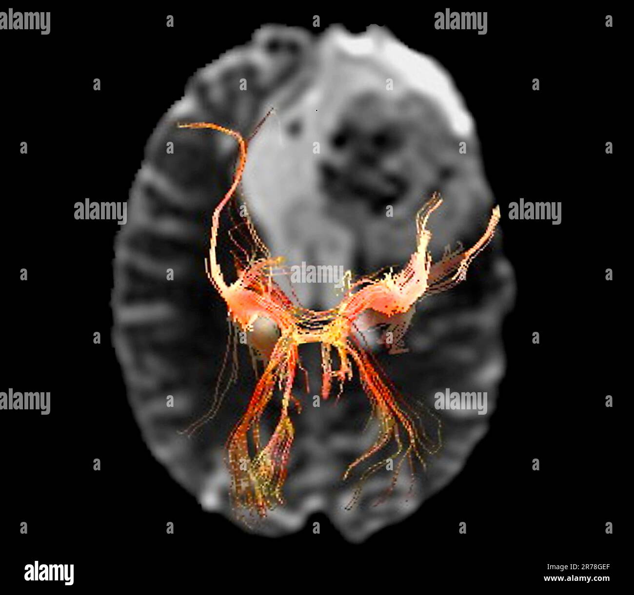 Farbdiffusionstensorbildgebung (DTI) (MRT) von Nervenbahnen (orange