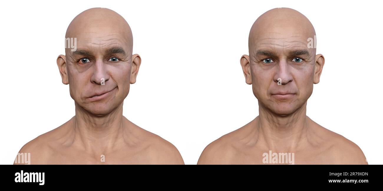 Fazialisparese bei einem Mann und demselben gesunden Mann, fotorealistische 3D-Darstellung, die die Asymmetrie und das Herabfallen der Gesichtsmuskeln auf einem si hervorhebt Stockfoto