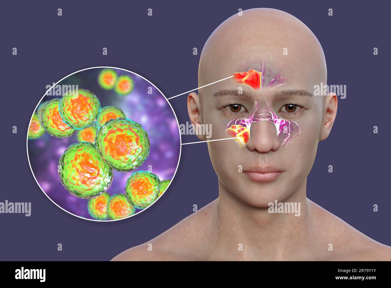 Moraxella-catarrhalis-Bakterien als Ursache einer Sinusitis. 3D Abbildung zeigt eitrige Entzündung der Stirn- und Kieferhöhlen und Nahaufnahme vi Stockfoto
