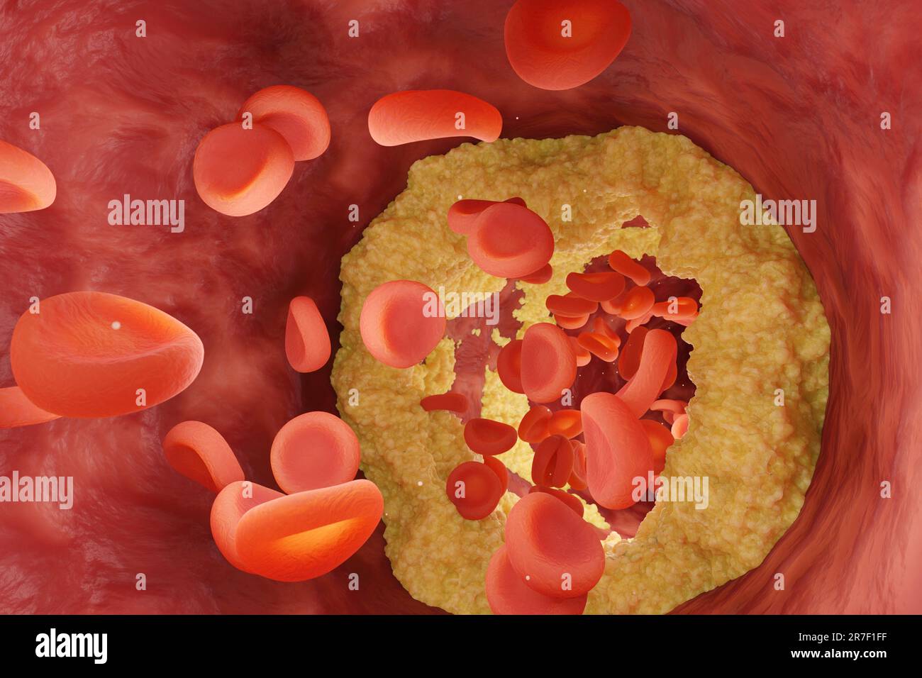 Blutgefässe durch Cholesterin verengt, durch die rote Blutkörperchen fließen. Illustration des Krankheitsbegriffs hoher Cholesterinspiegel Stockfoto