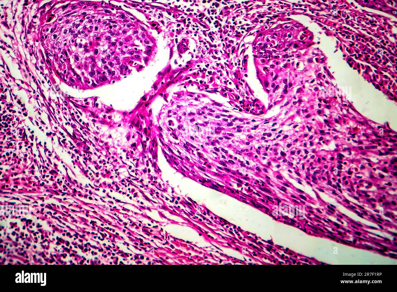 Gebärmutterhalskrebs. Licht Schliffbild (LM), einen Abschnitt über ein Plattenepithelkarzinom der Zervix. Gebärmutterhalskrebs ist eine Krebserkrankung des Gebärmutterhalses, wh Stockfoto