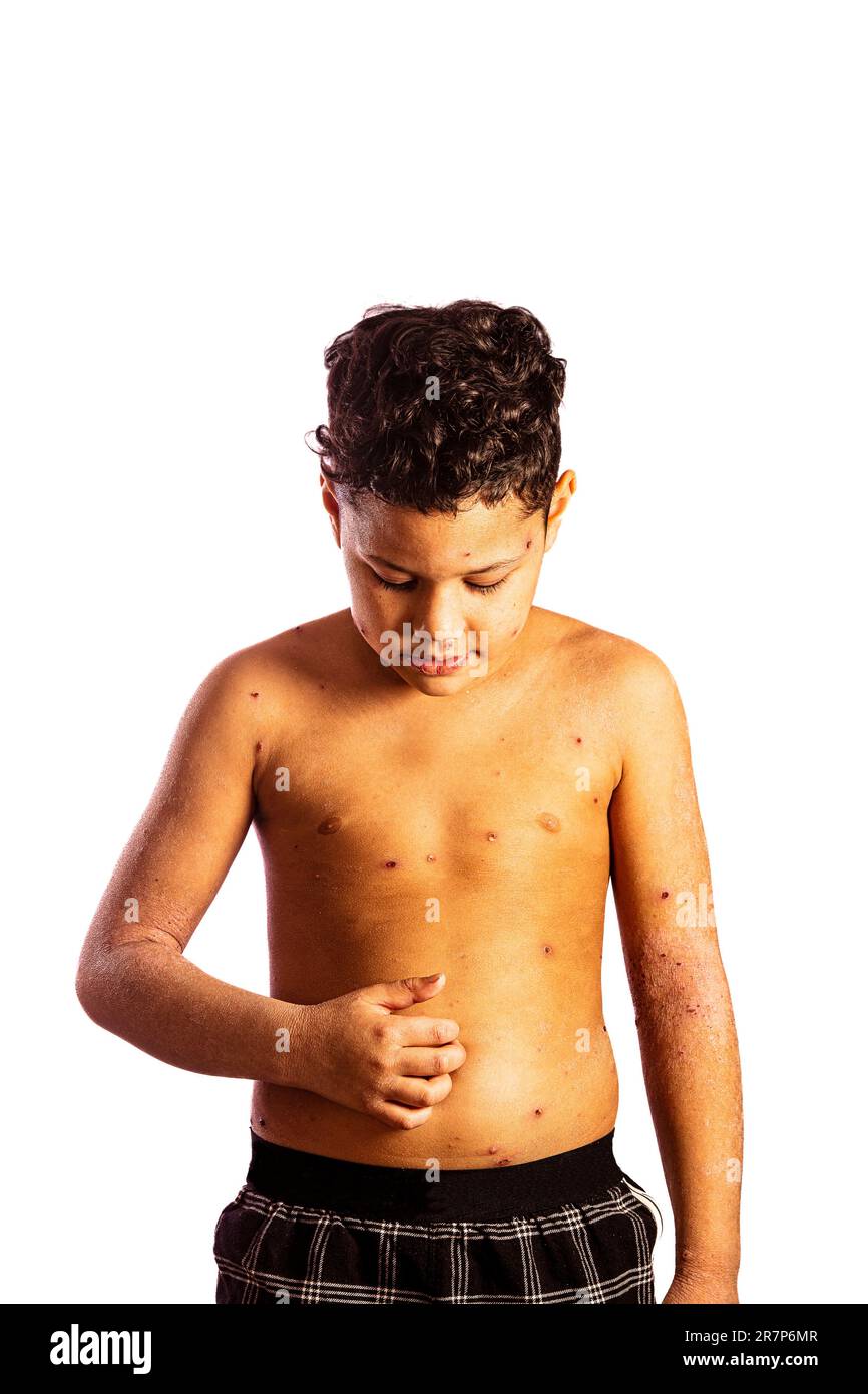 Ein siebenjähriger Junge mit Windpocken. Windpocken sind eine hoch ansteckende Virusinfektion. Sie breitet sich leicht von Mensch zu Mensch aus und tritt am häufigsten bei Kleinkindern auf. Das Hauptsymptom ist ein juckender, fleckiger Ausschlag mit kleinen Blasen, die sich über den ganzen Körper ausbreiten können. Für die meisten Menschen sind Windpocken nichts Ernstes und heilen von selbst innerhalb weniger Wochen. Die Symptome können mit Kühlcremes und Schmerzmitteln gelindert werden. Stockfoto