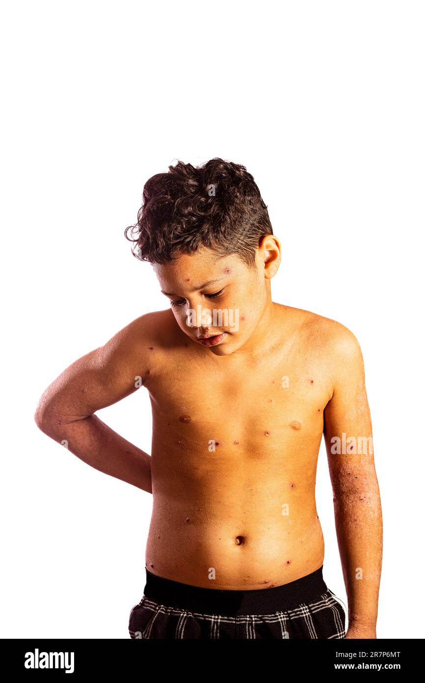 Ein siebenjähriger Junge mit Windpocken. Windpocken sind eine hoch ansteckende Virusinfektion. Sie breitet sich leicht von Mensch zu Mensch aus und tritt am häufigsten bei Kleinkindern auf. Das Hauptsymptom ist ein juckender, fleckiger Ausschlag mit kleinen Blasen, die sich über den ganzen Körper ausbreiten können. Für die meisten Menschen sind Windpocken nichts Ernstes und heilen von selbst innerhalb weniger Wochen. Die Symptome können mit Kühlcremes und Schmerzmitteln gelindert werden. Stockfoto