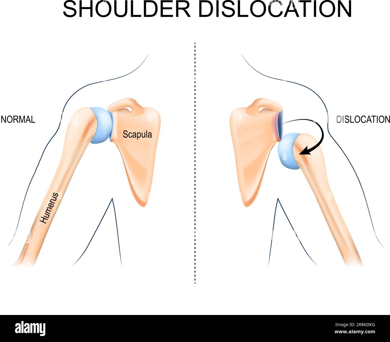 Schulterluxation. Oberarmknochentrauma, Sportverletzungen oder schwache Schultermuskulatur. Die Anatomie des menschlichen Arms. Knochen und Gelenk der Schulter und Hand. Stock Vektor