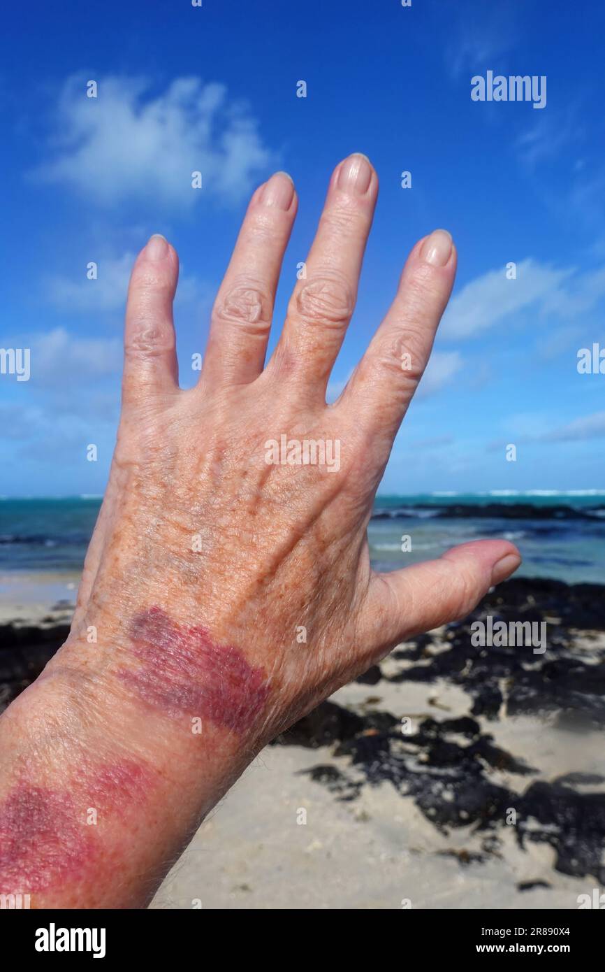 Purpura, senile Purpura Stockfoto
