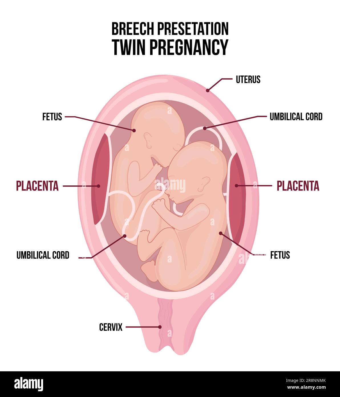 Zur Anatomie des Zwillingsabdomens. Schwangerschaftsdiagramme mit Beckenendlage für beide Kinder. Kopf oben bei der Frau. Vektormedizin Stock Vektor