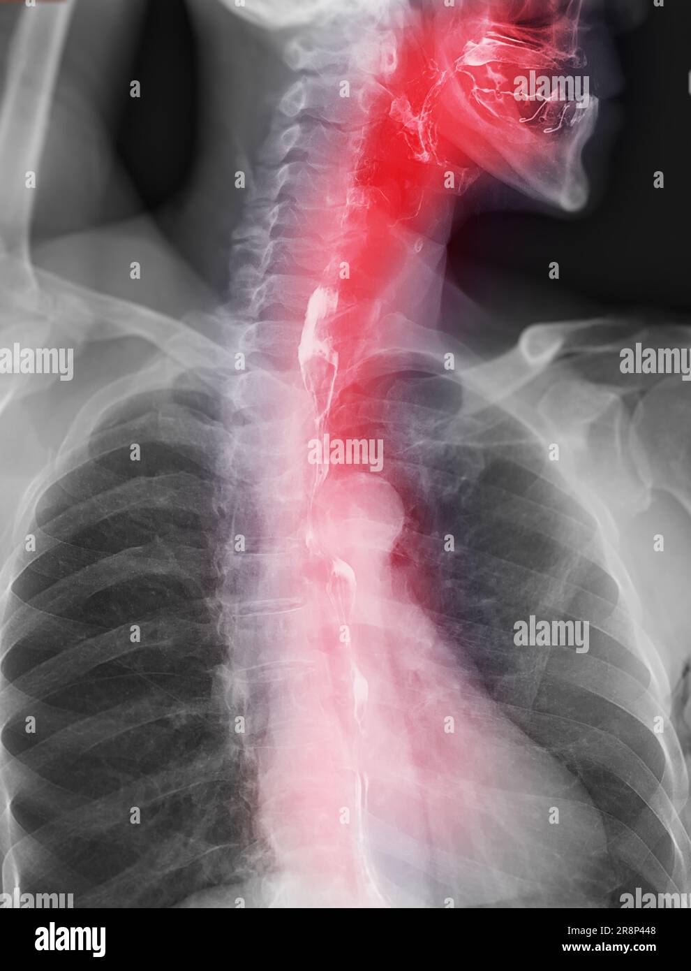 Barium Swallow study Test diagnostiziere Barrett's GI tract exam GERD ulcers series difficulty pharynx procedure UGI throat darm therapy by Fluoroscopy dev Stockfoto