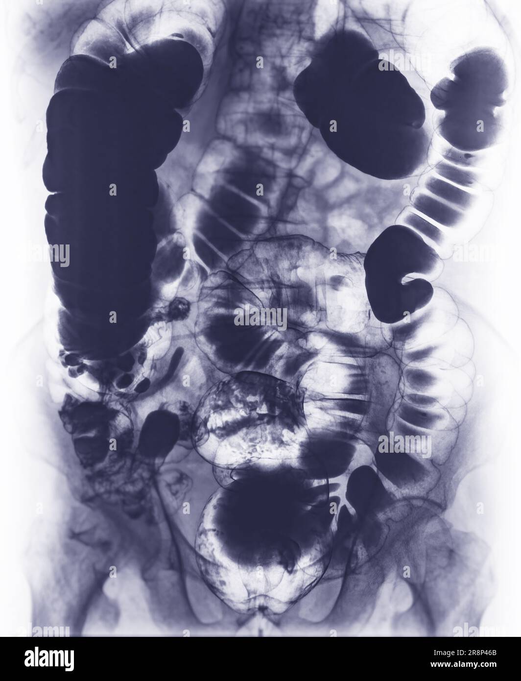 Bariumeinemuntersuchung oder Röntgenbild des Dickdarms. Stockfoto