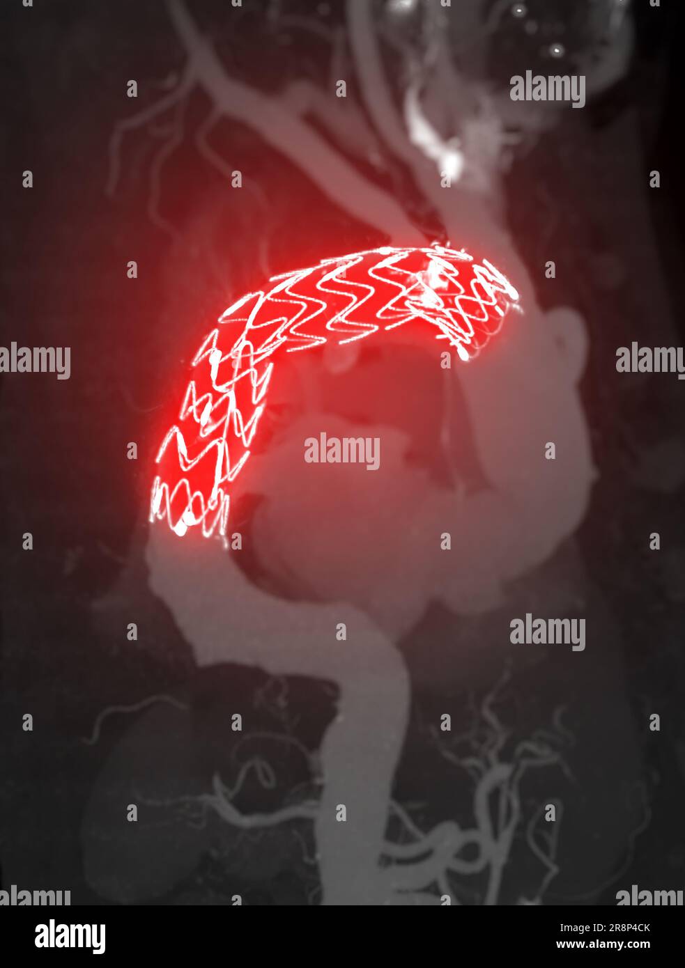 CTA-Ganzaorta mit thorakalem Aortenstent-Transplantat 3D-Rendering bei abdominellen Aortenaneurysmen. Stockfoto