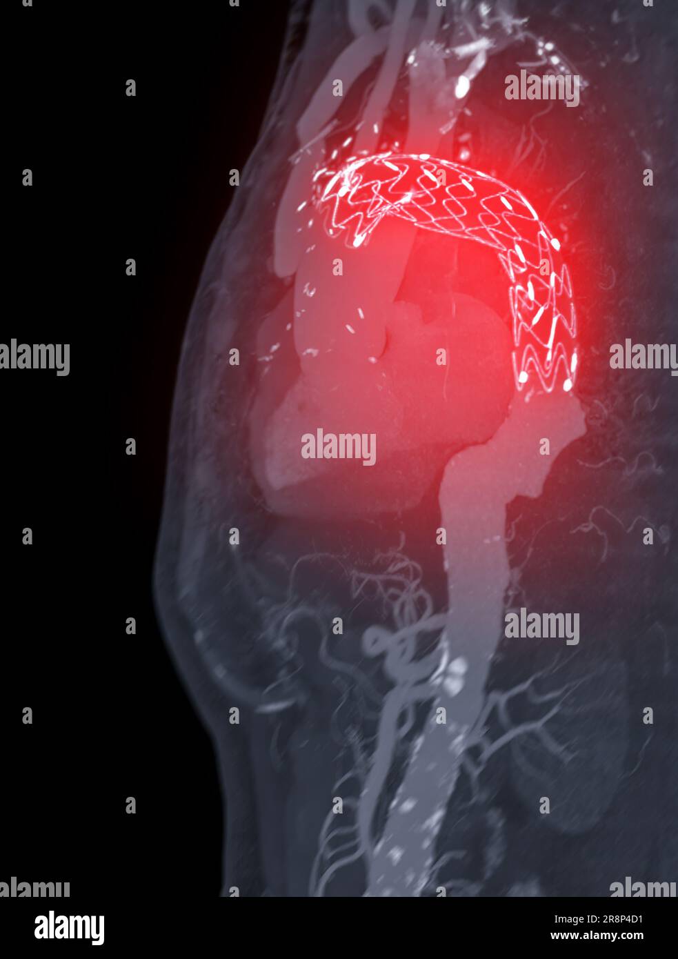 CTA-Ganzaorta mit thorakalem Aortenstent-Transplantat 3D-Rendering bei abdominellen Aortenaneurysmen. Stockfoto