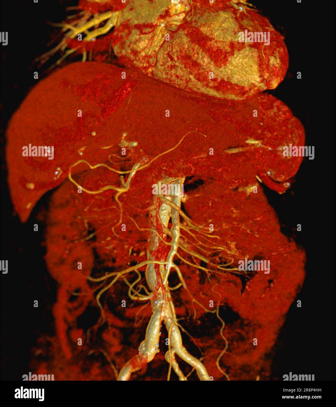 CTA-3D-Rendering der gesamten Aorta. Stockfoto