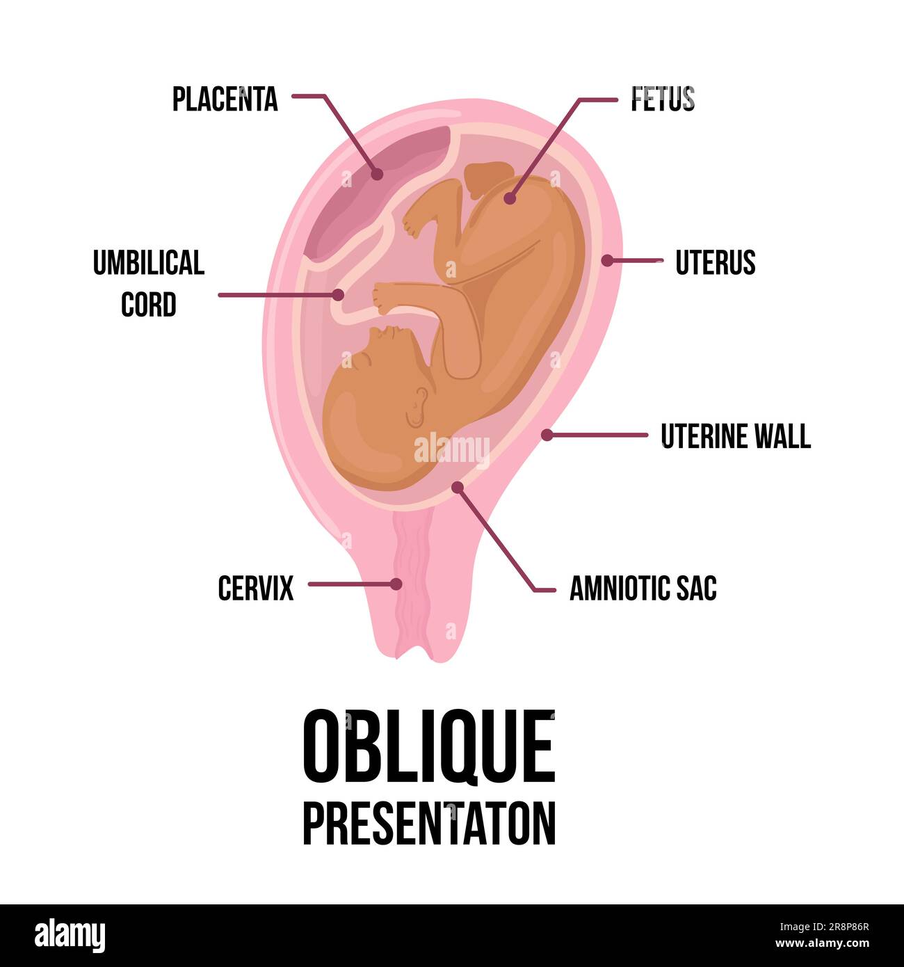 Die schräge Babylage im Uterus während der Schwangerschaft. Gefährliche Situationen. Farbiges medizinisches Vektordiagramm mit Begriffen. Fötus mit Nabelschnur und Ort Stock Vektor