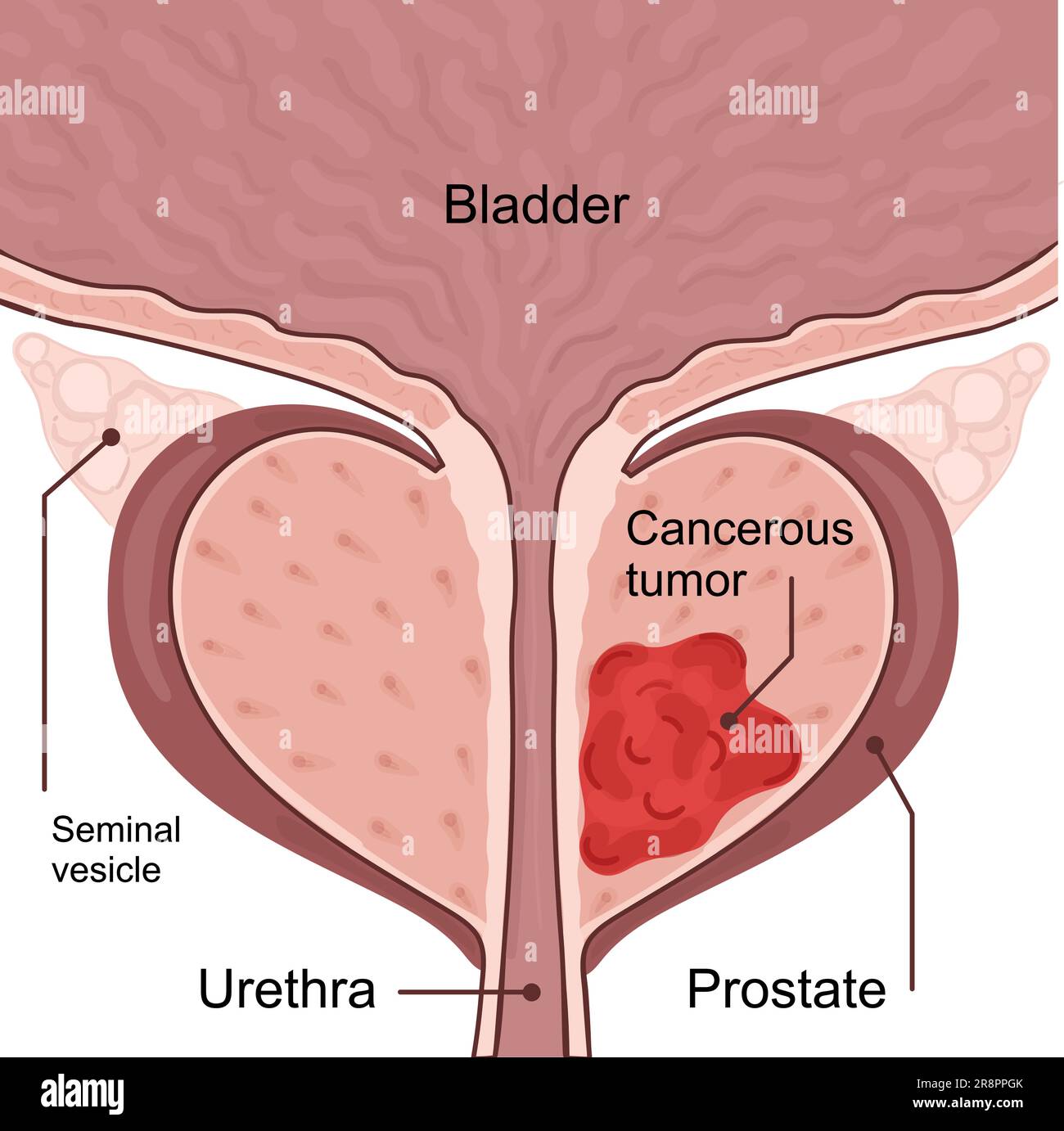 Medizinisches Diagramm von 2 Stadien des Prostatakarzinoms. Der Tumor wächst und dringt in benachbarte Organe und Gewebe ein. vektordarstellung. Stock Vektor