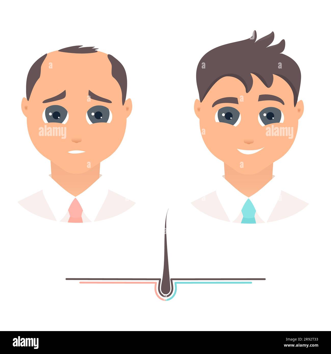 Ergebnis der männlichen Haartransplantation, Illustration Stockfoto