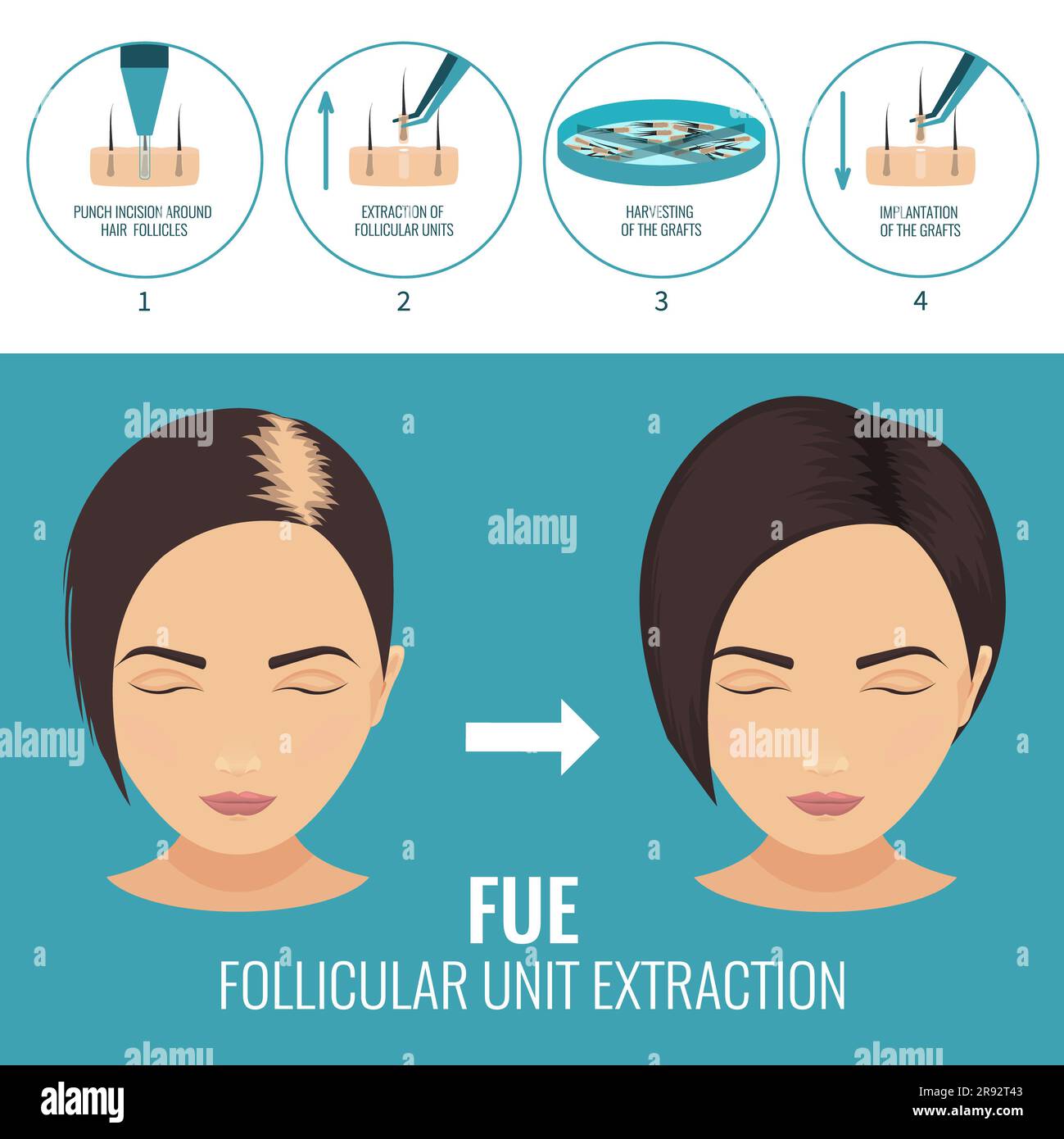 FUE-Haartransplantation, Illustration Stockfoto