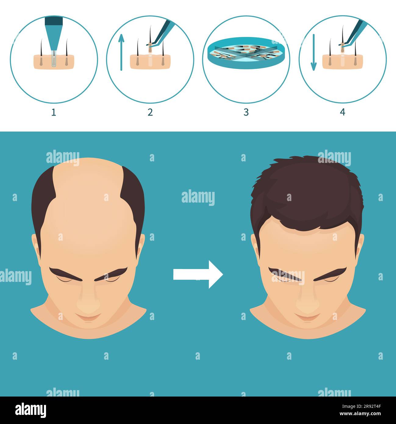 FUE-Haartransplantation, Illustration Stockfoto