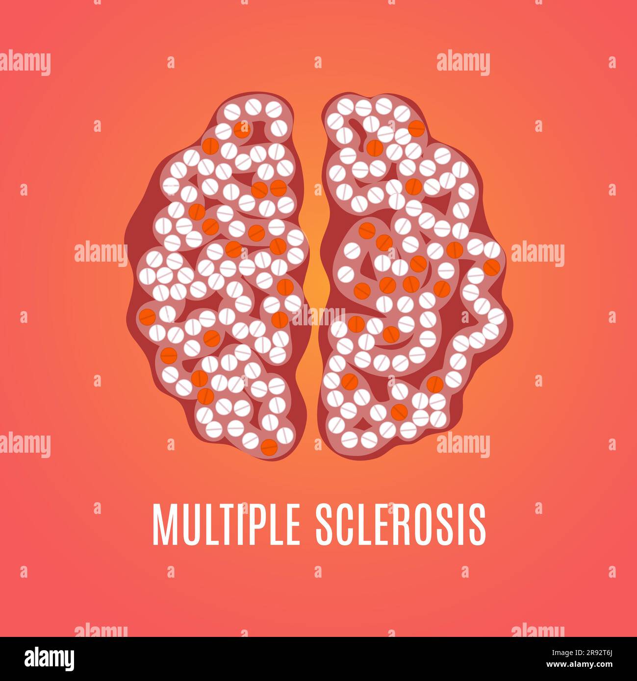 Multiple Sklerose, konzeptuelle Illustration Stockfoto