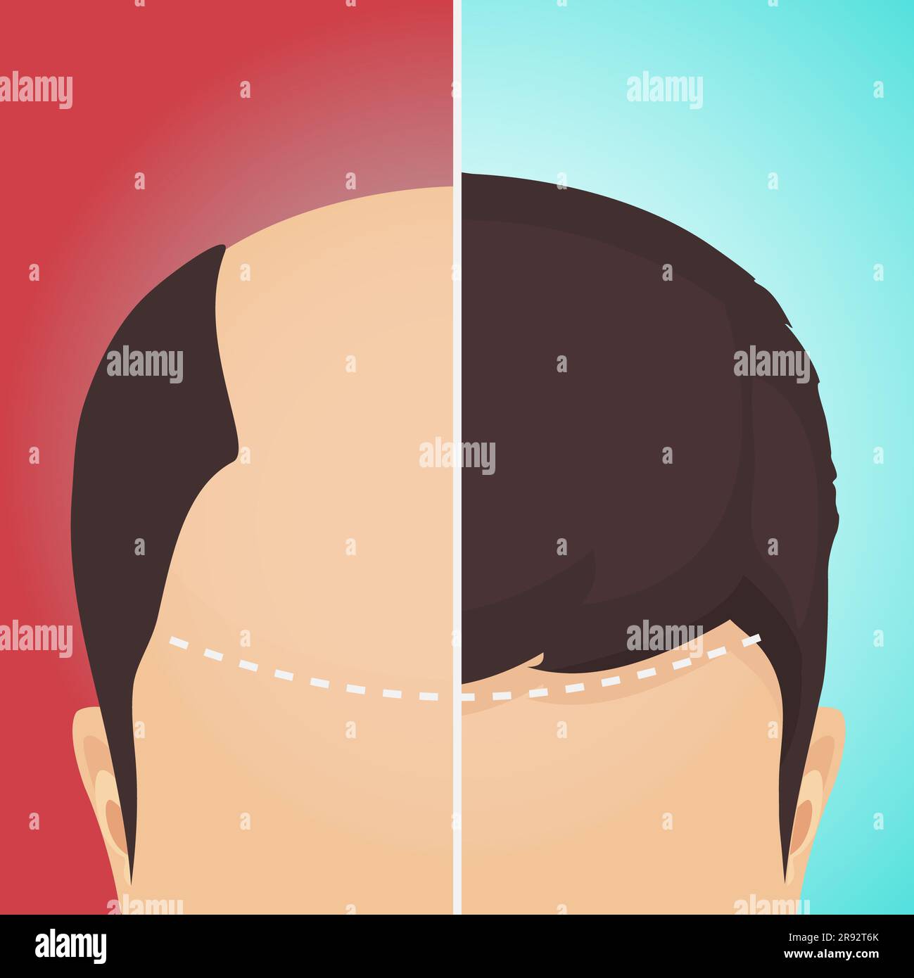 Haartransplantation, Illustration Stockfoto