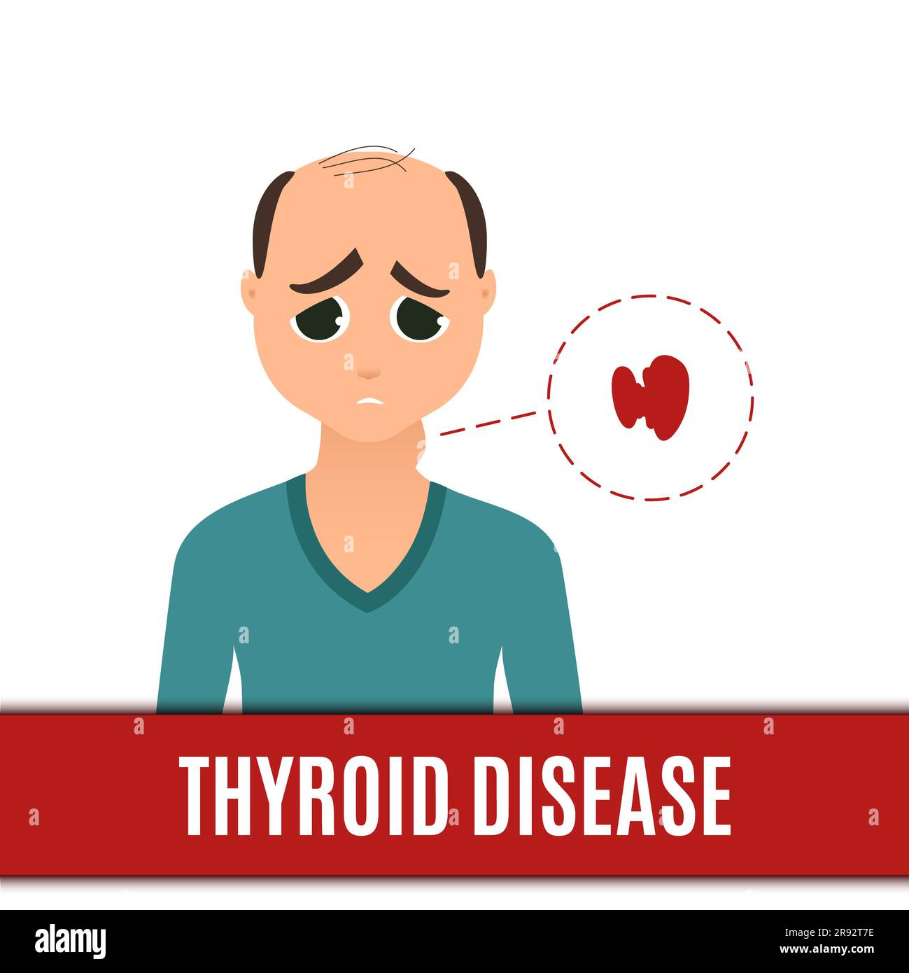 Schilddrüsenstörung, konzeptuelle Illustration Stockfoto