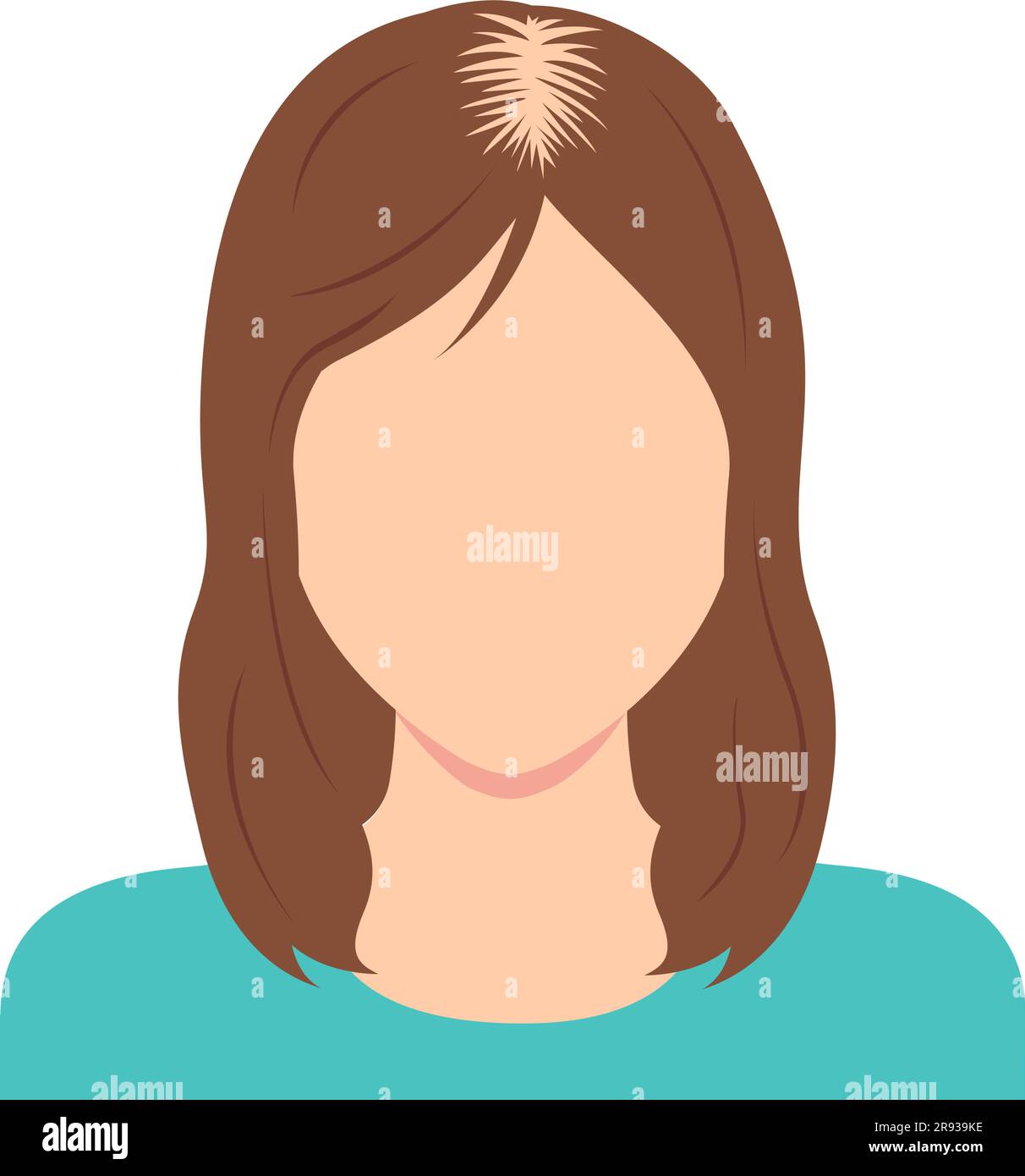 Weibliche androgenetische Alopezie Vektor-Illustration Stock Vektor