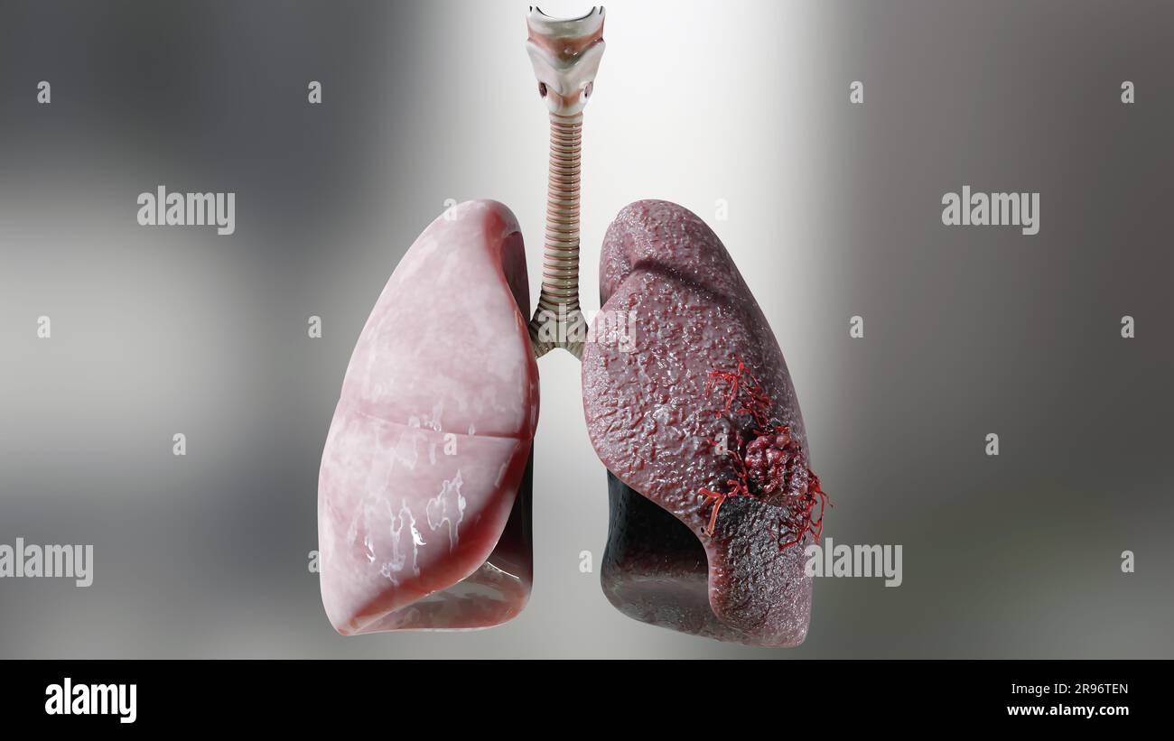 Lungenentzündung Krankheit, gesunde Lungen und Krankheit Lungen, menschlicher Lungenkrebs, Zigarettenraucher Lungenkrankheit, Krebs bösartige Tumore wachsen und Spreadin Stockfoto