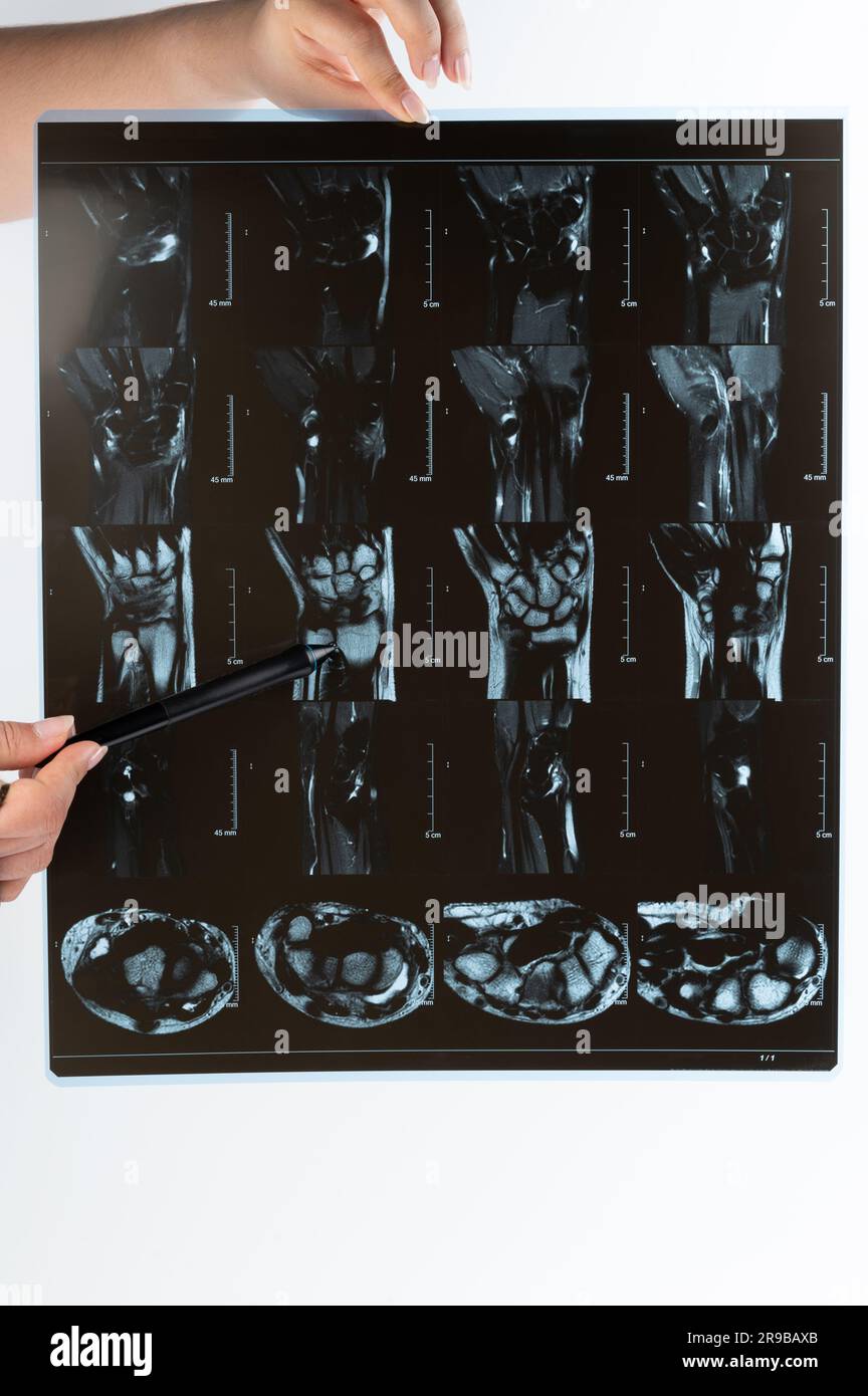 Der Arzt zeigt ein radiologisches Röntgenbild der Nahaufnahme des Handteils Stockfoto