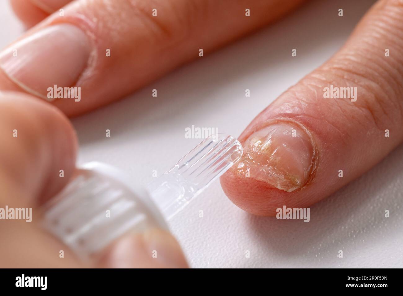 Nagelpilzinfektionsbehandlung. Applikation von Amorolfine-Antimykotikallack auf den Fingernagel der Hand Stockfoto