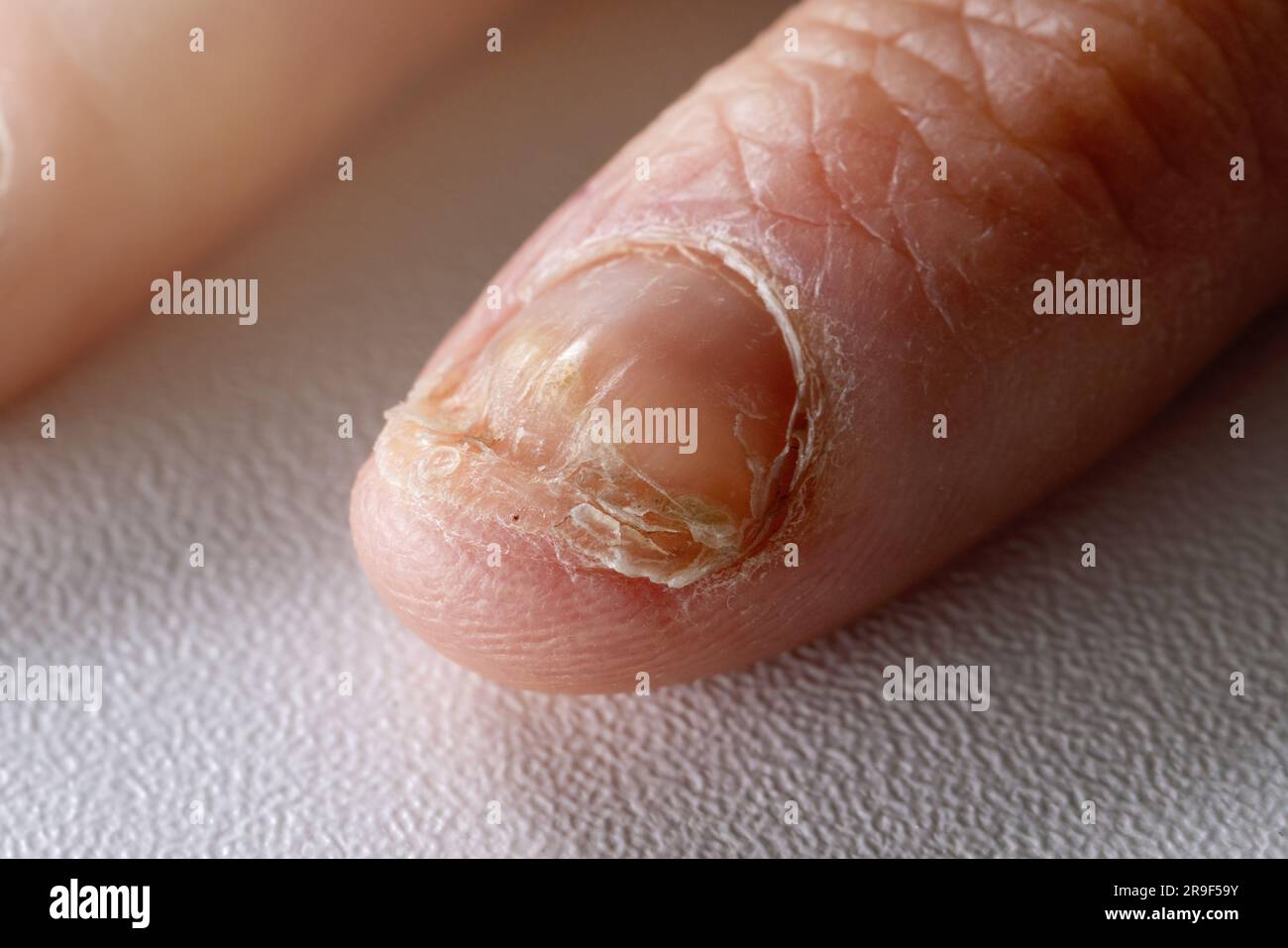 Pilzinfektion. Nagelpilz Candida am Fingernagel Stockfoto
