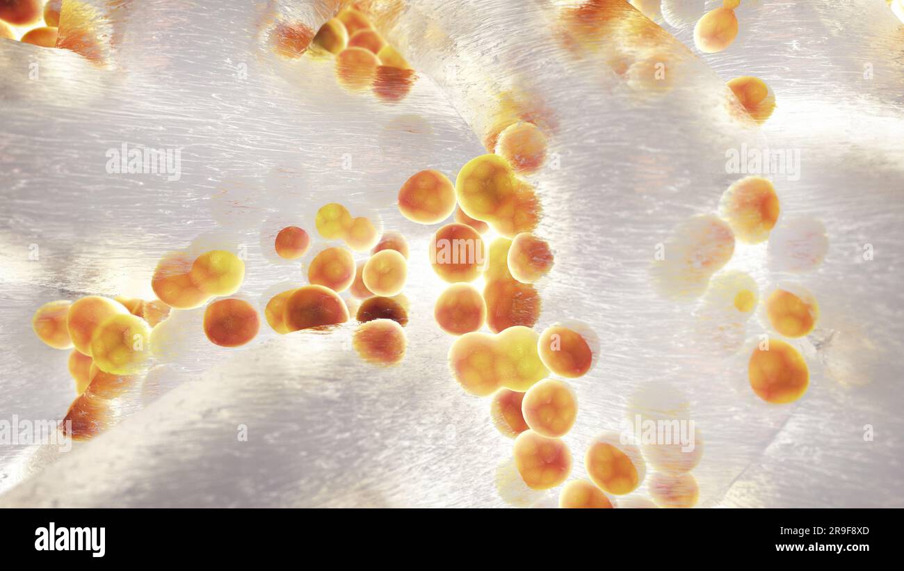 Kolonie von Staphylococcus aureus-Bakterien. Staphylokokken sind die häufigste Ursache von Biofilm-assoziierten Infektionen. Bakterielle Biofilme Stockfoto