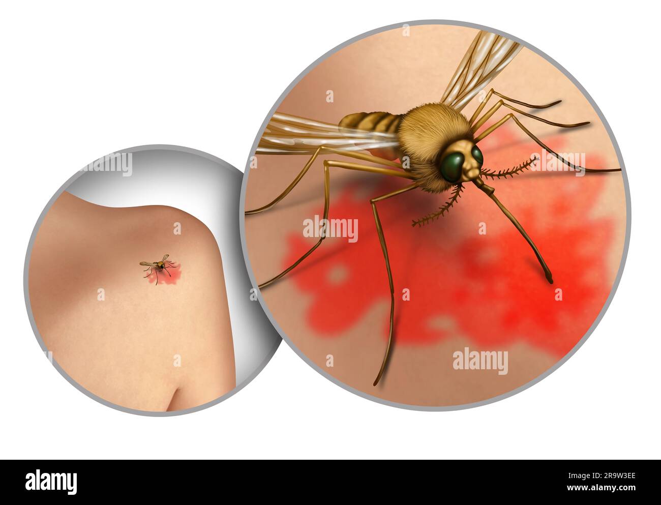 Die Ausbreitung der Mückenkrankheit und das Risiko von Stechmücken und Stechmücken im Freien, die schädliche Infektionen als Malaria und das zika-Virus als Insekt übertragen Stockfoto
