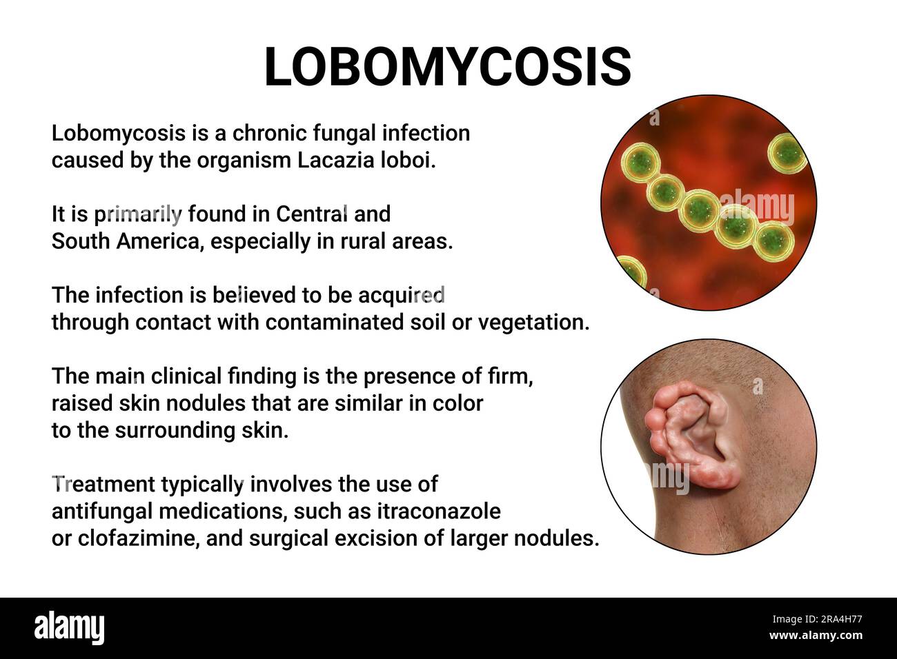 Lobomykose-Pilzinfektion, Illustration Stockfoto