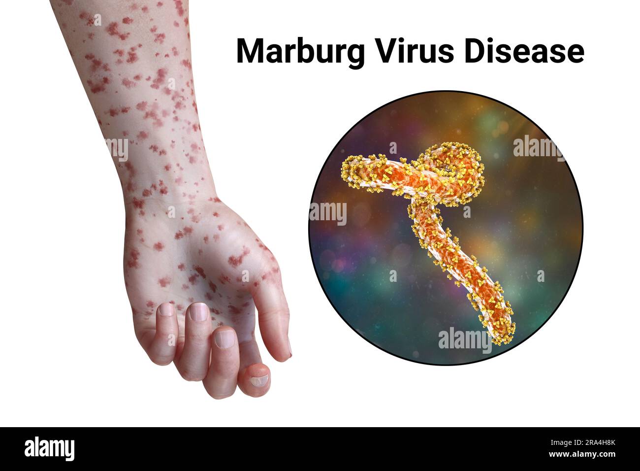 Hautausschlag bei Marburger hämorrhagischem Fieber, Illustration Stockfoto