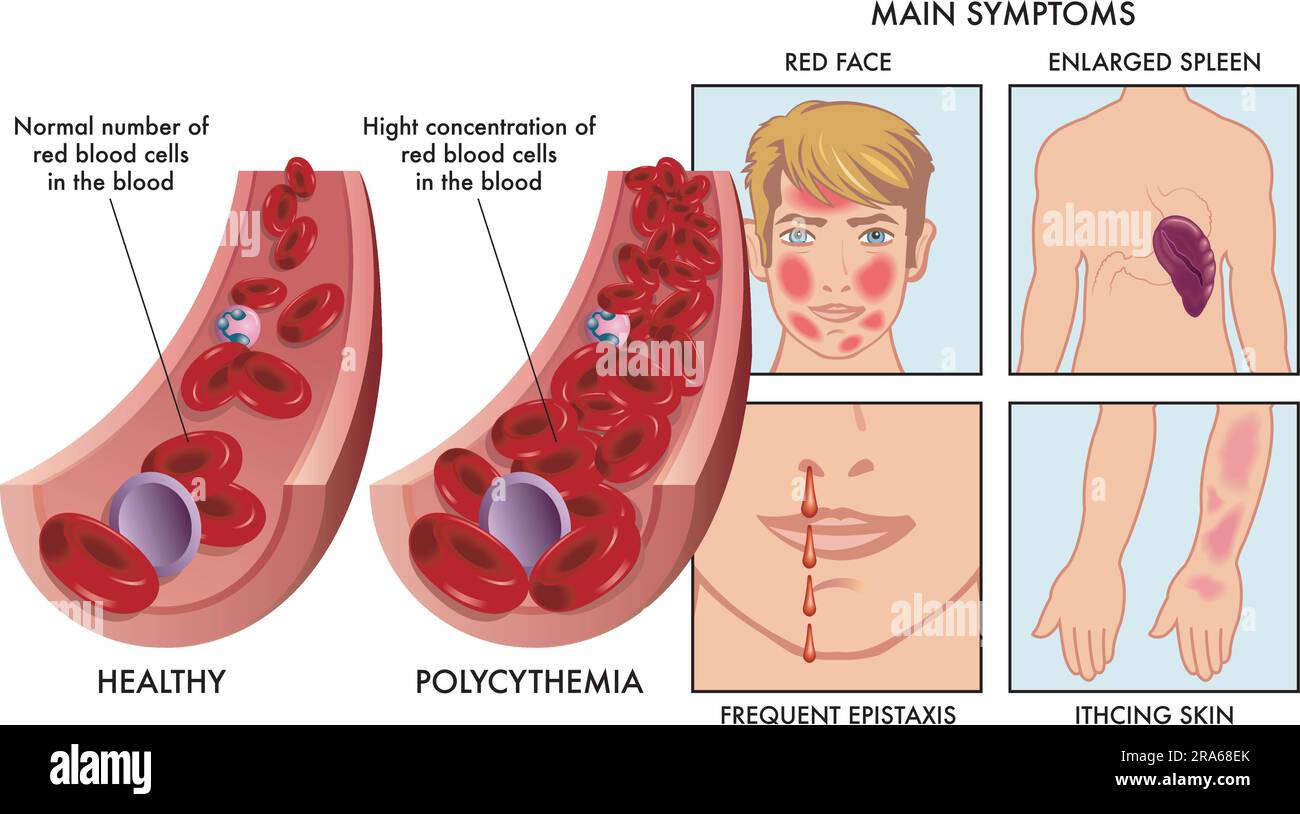 Die medizinische Illustration vergleicht eine Arterie mit einer normalen Anzahl roter Blutkörperchen, wobei eine von Polyzythämie betroffen ist, wobei Zeichnungen rechts gezeigt werden Stock Vektor