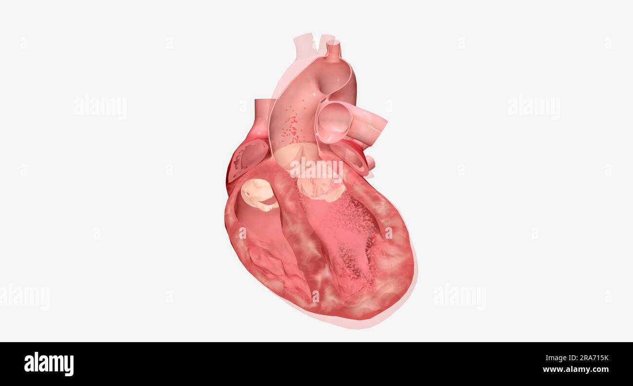 Herzinsuffizienz ist eine anhaltende Erkrankung, die mehrere