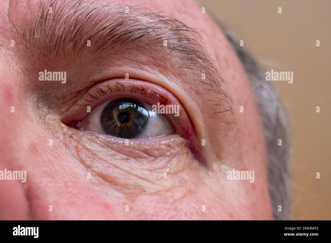 Nahaufnahme eines menschlichen Auges nach einer Operation zur Entfernung eines Papilloms (kleiner Knoten) aus seinem Augenlid, London, UK. Stockfoto