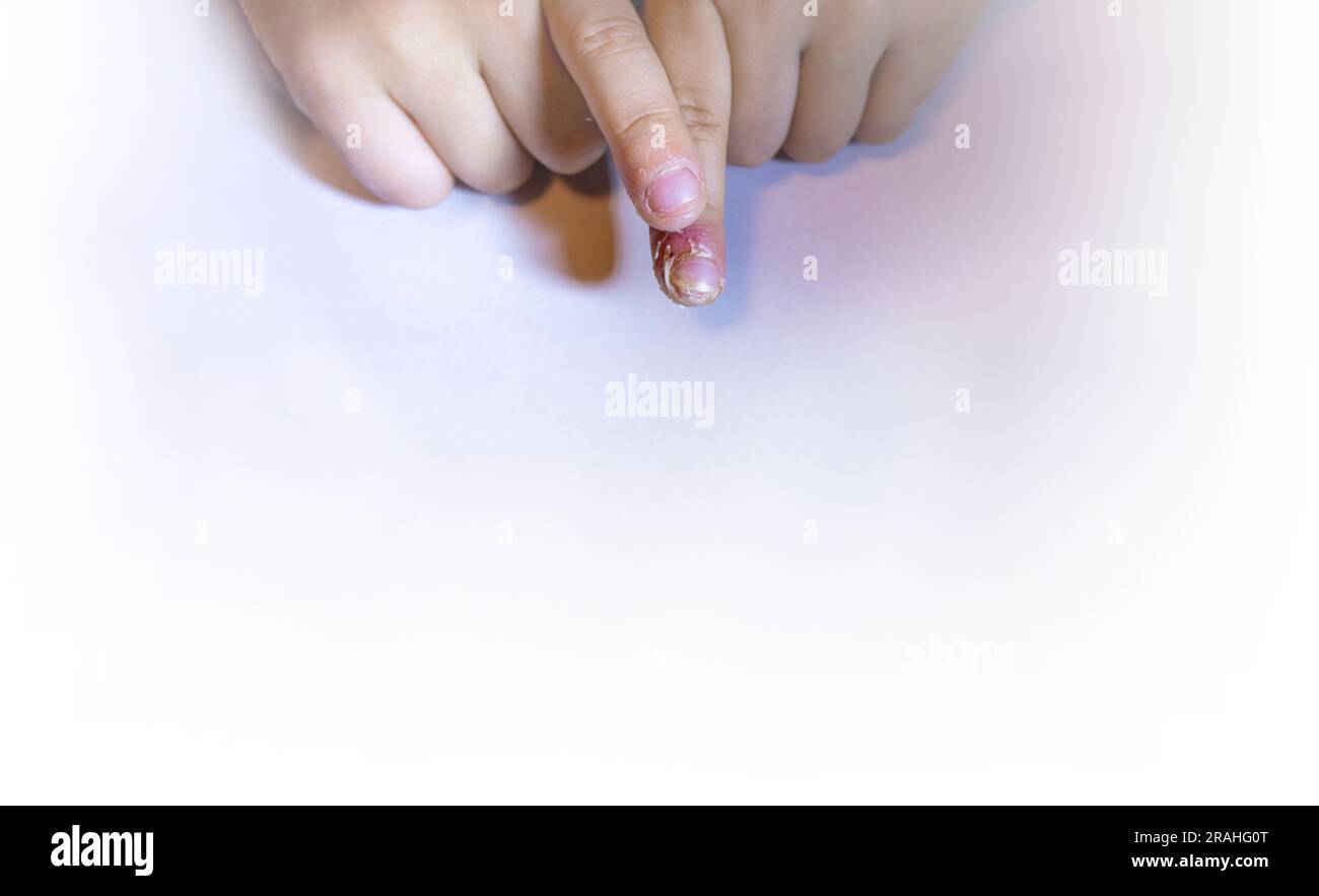 Finger geschwollen mit Entzündung durch Nagelriss-Infektion Stockfoto